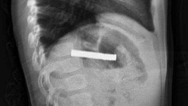 Boğazından 19 adet mıknatıs çıkartıldı